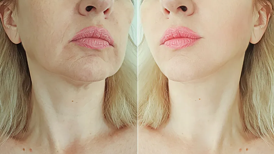 Before and after result